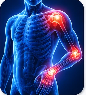 Arthritis